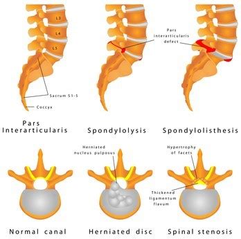 spondylolisthesis physiopedia.